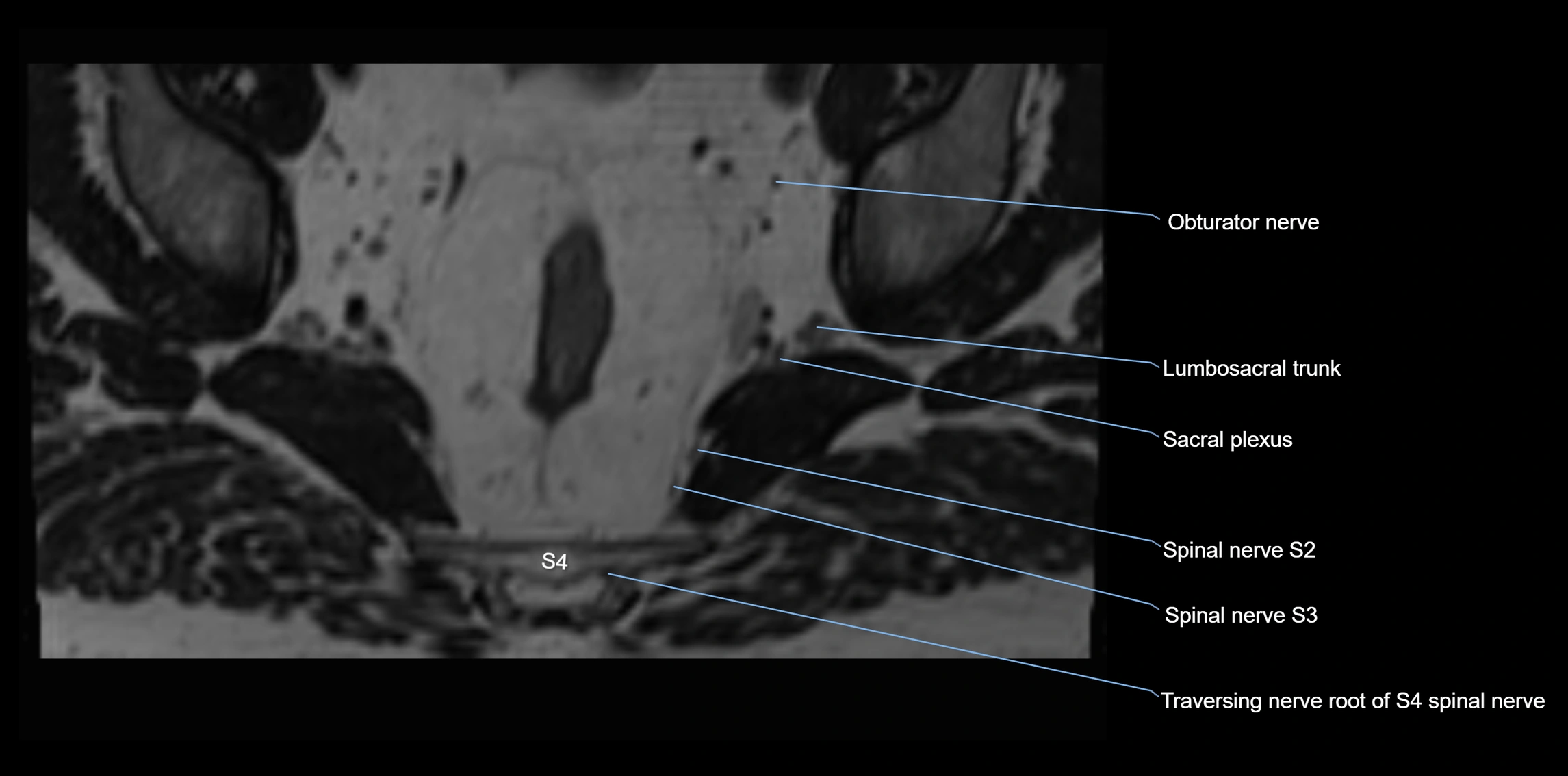 MR lumbosacral plexus axial cross sectional anatomy 3T  radiology  image-img-1008001-00101.webp